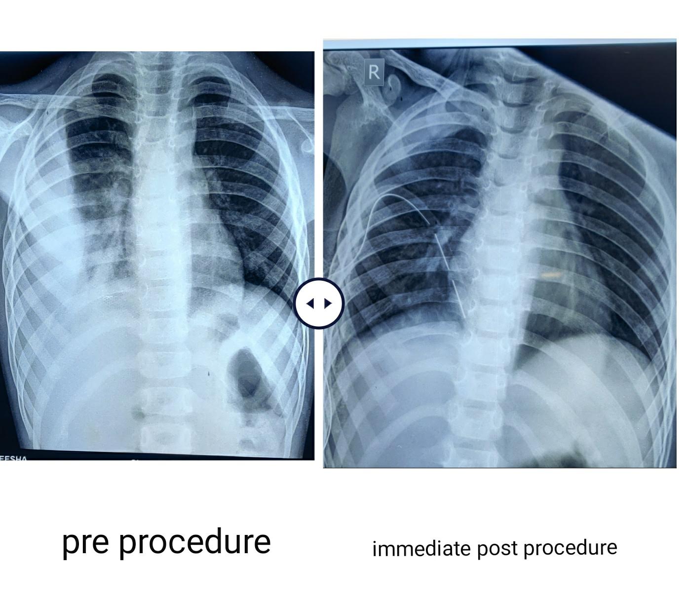 Pre-post1